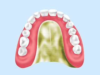 【金属床義歯】