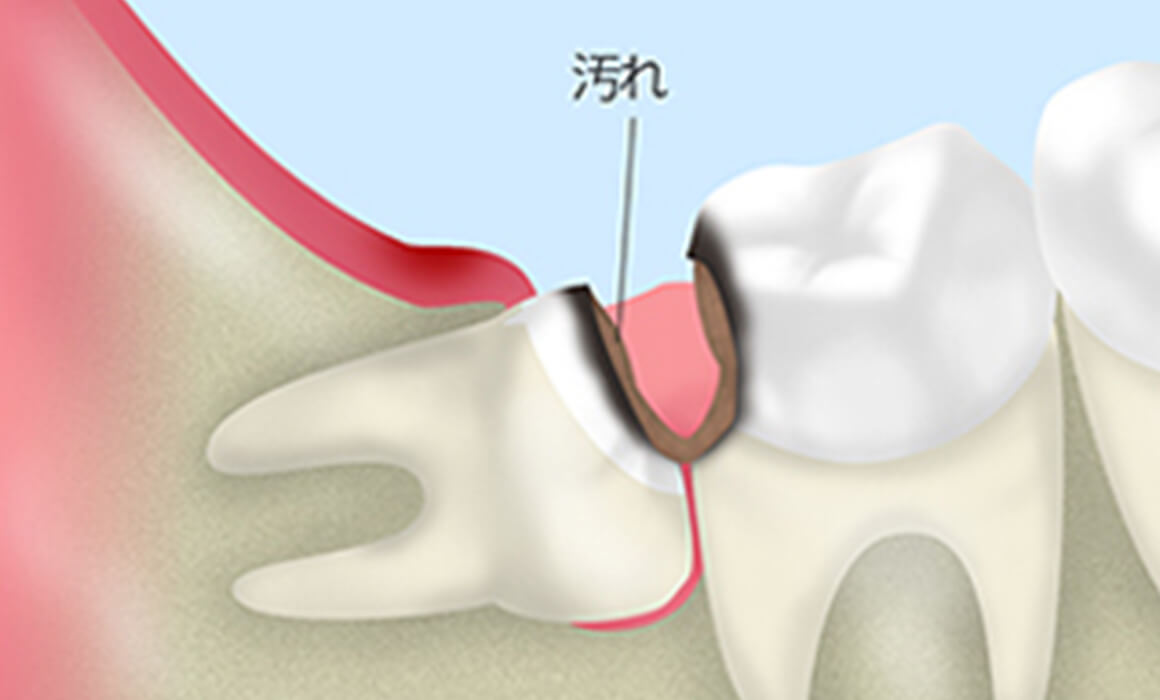 親知らずの抜歯