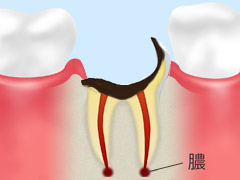 C4：歯根に達した虫歯