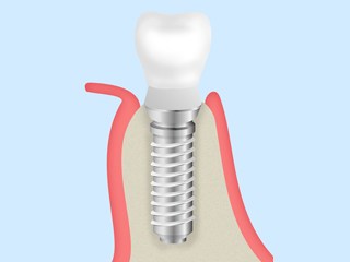 抜歯即時インプラント