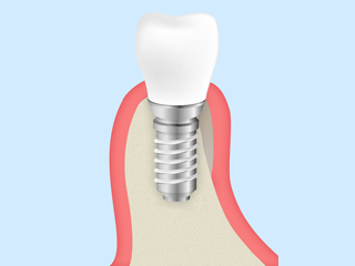 ショートインプラント