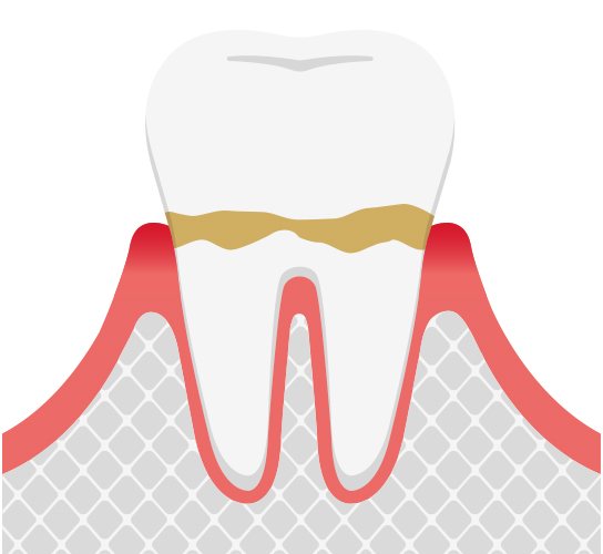 歯肉炎